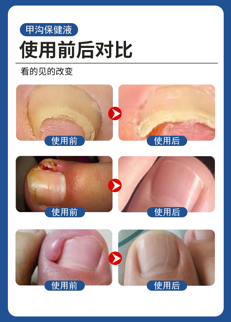 甲溝炎專用液有用嗎？使用前后對(duì)比